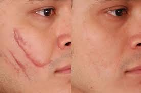 Photo of A Scar-Free Look – Get 10% off on Scar Removal Treatment